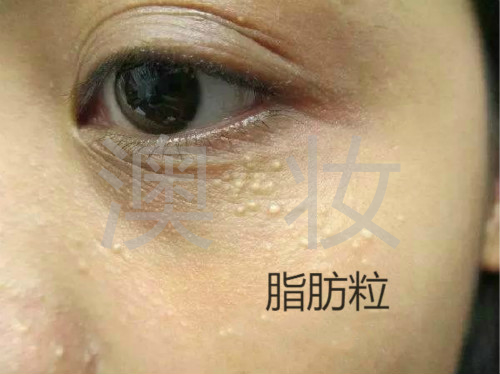 澳妆:脂肪粒,汗管瘤,扁平疣别再傻傻分不清了